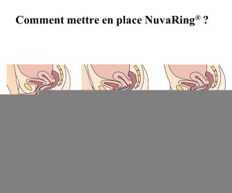 comment mettre ovule